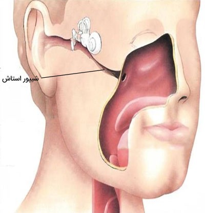 معافیت پزشکی بیماری های گوش و حلق و بینی: عفونت گوش