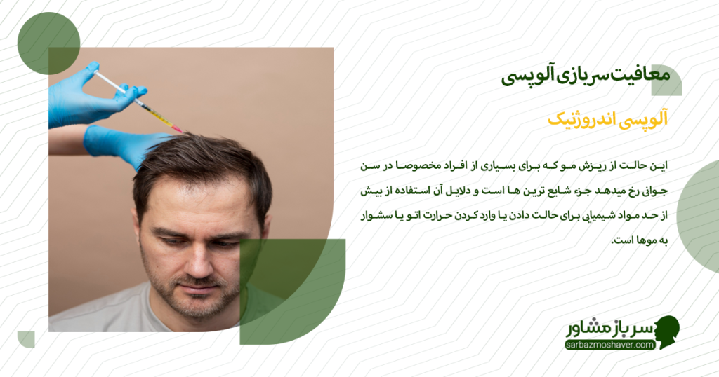 آلوپسی اندروژنیک