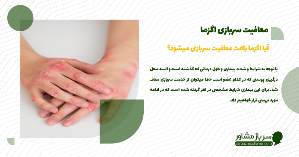 آیا اگزما باعث معافیت سربازی میشود؟